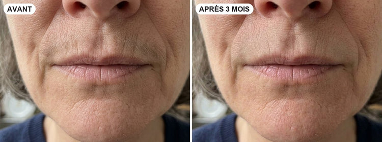 Au-dessus de la lèvre, avant et après 3 mois.