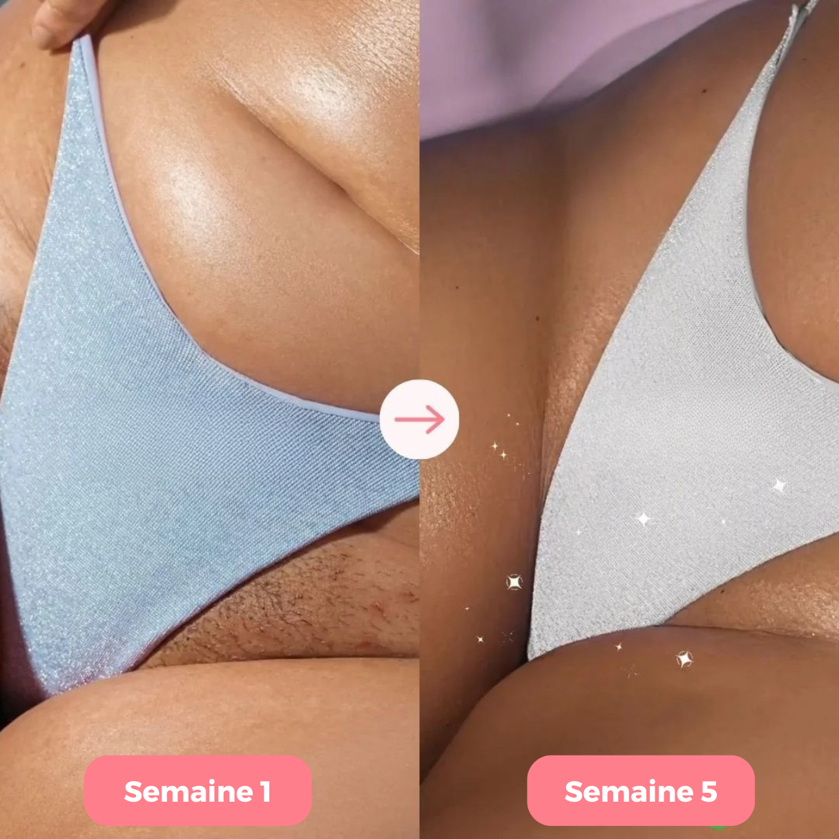 Épilateur Koliza Pro™ 2.0