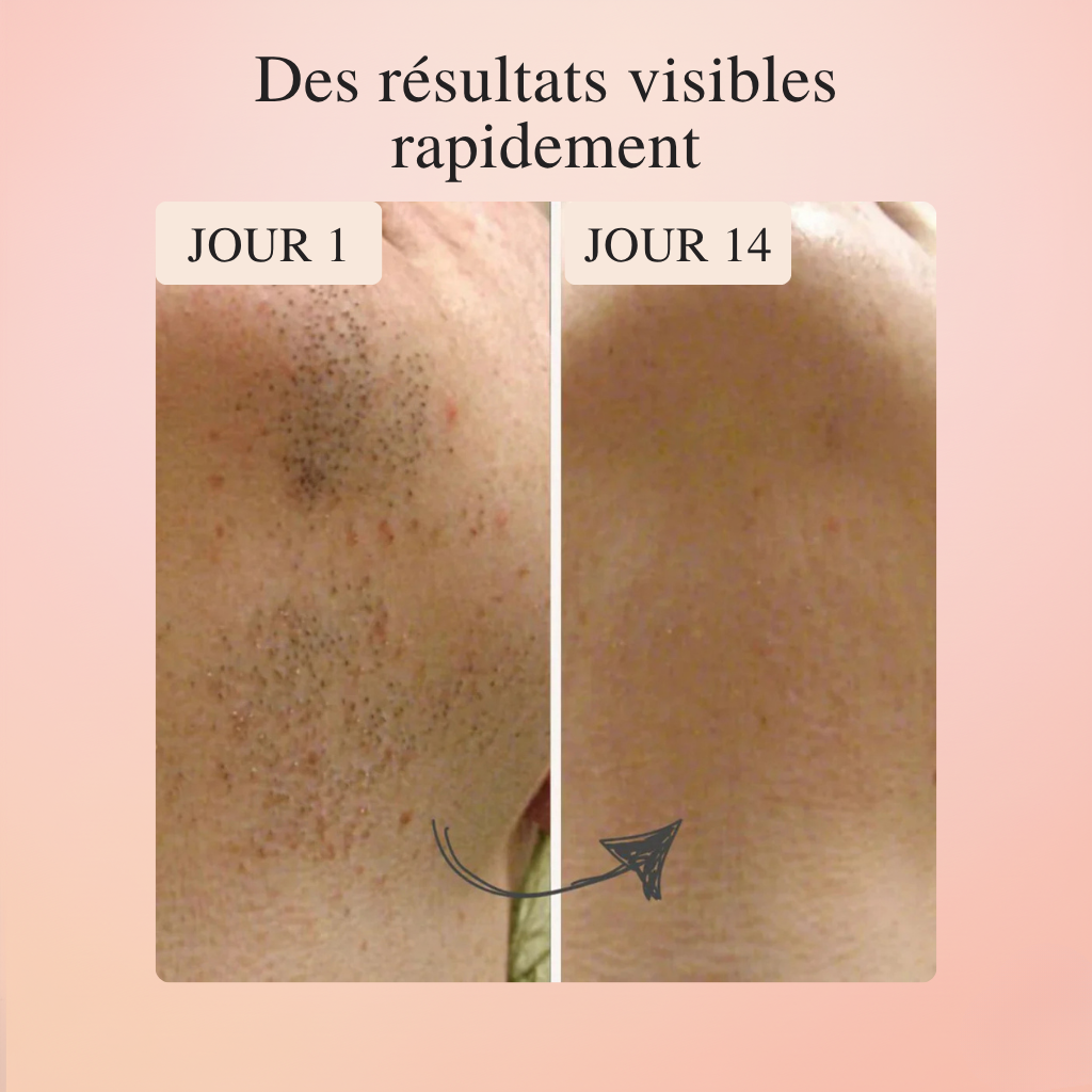 Koliza - IPL Epilator