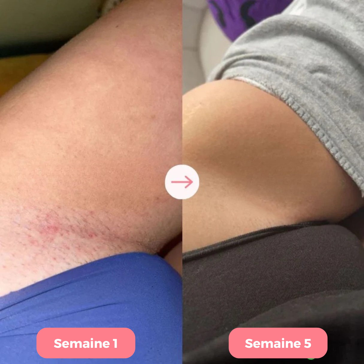 Épilateur Koliza Pro™ 2.0