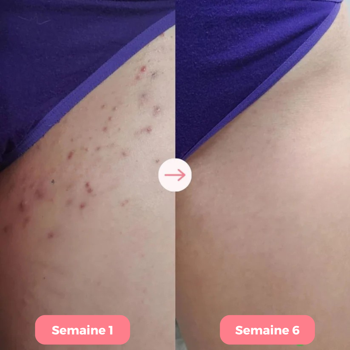 Épilateur Koliza Pro™ 2.0