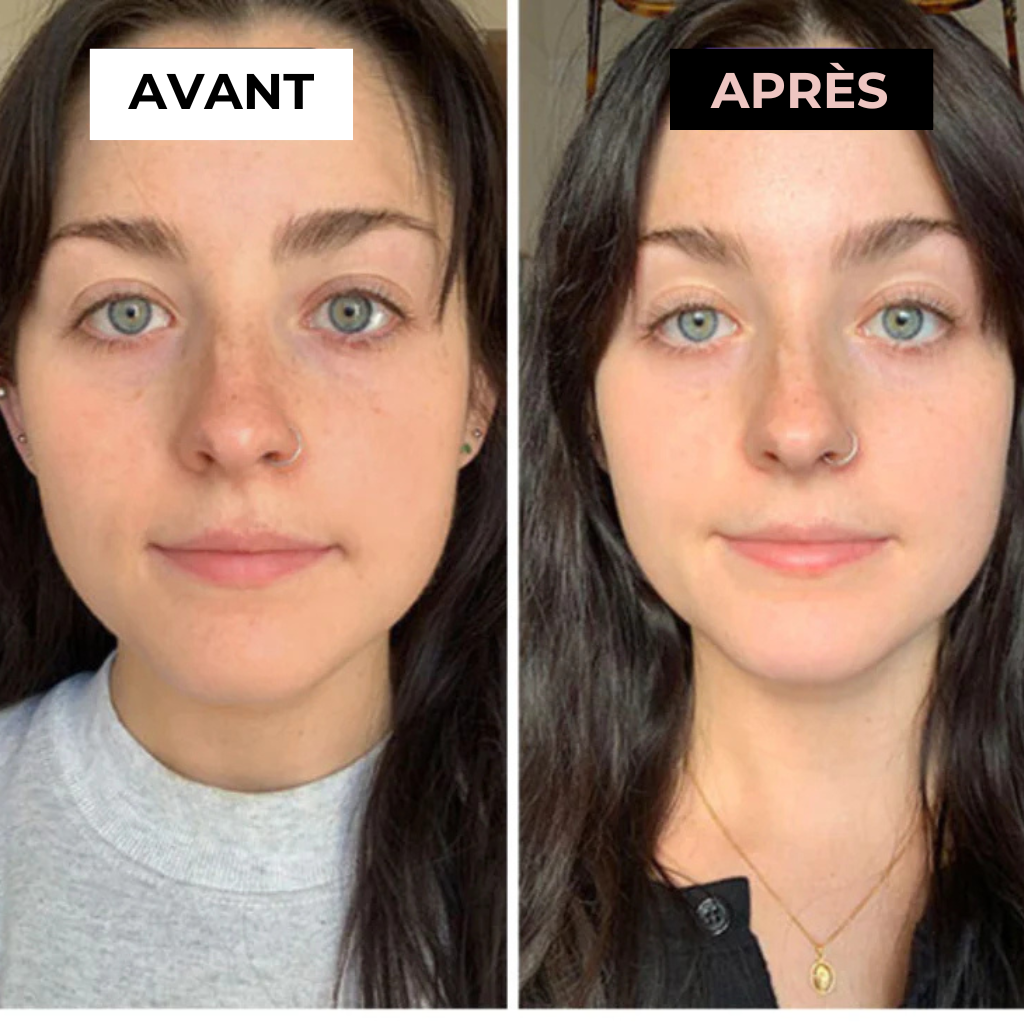 Masseur Noreska | Anti-acné et Anti-rides