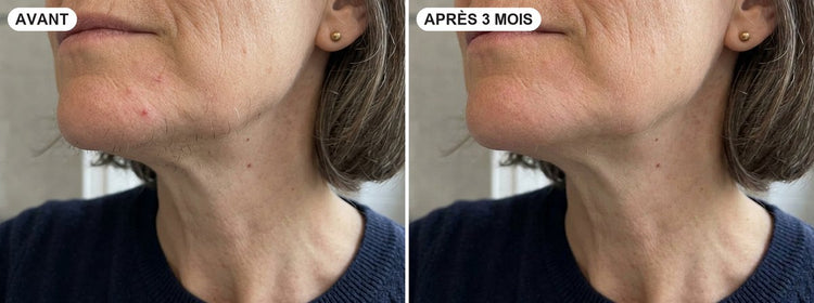 Mon menton, jour 1 et après 3 mois.