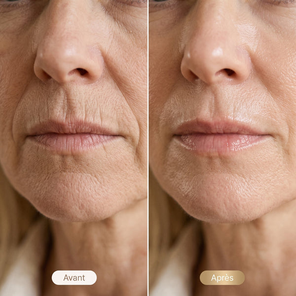 Contour de bouche · après 6 séances