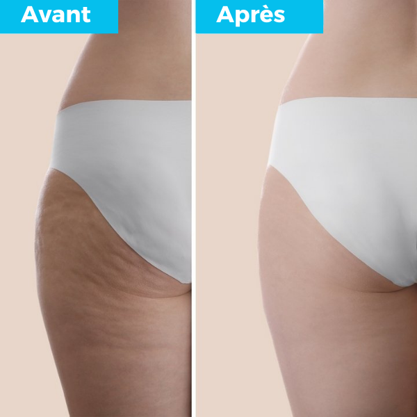 50% de réduction | Koliza™️ Masseur infrarouge anti-cellulite 5 en 1